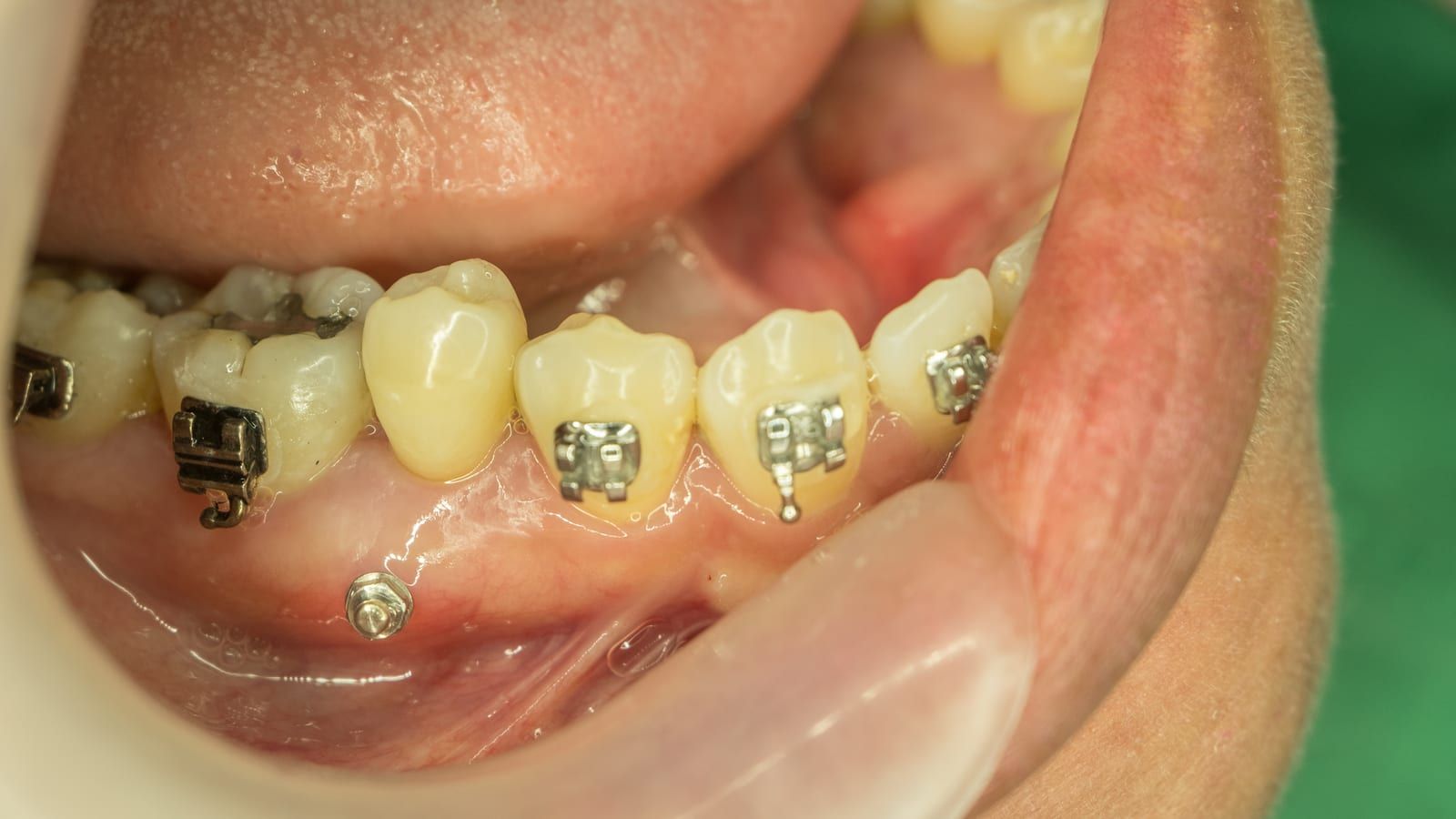 Mini Dental Implants Are Your Restoration Option At Dentistry Of Miami   MiniImplant1 .optimal 