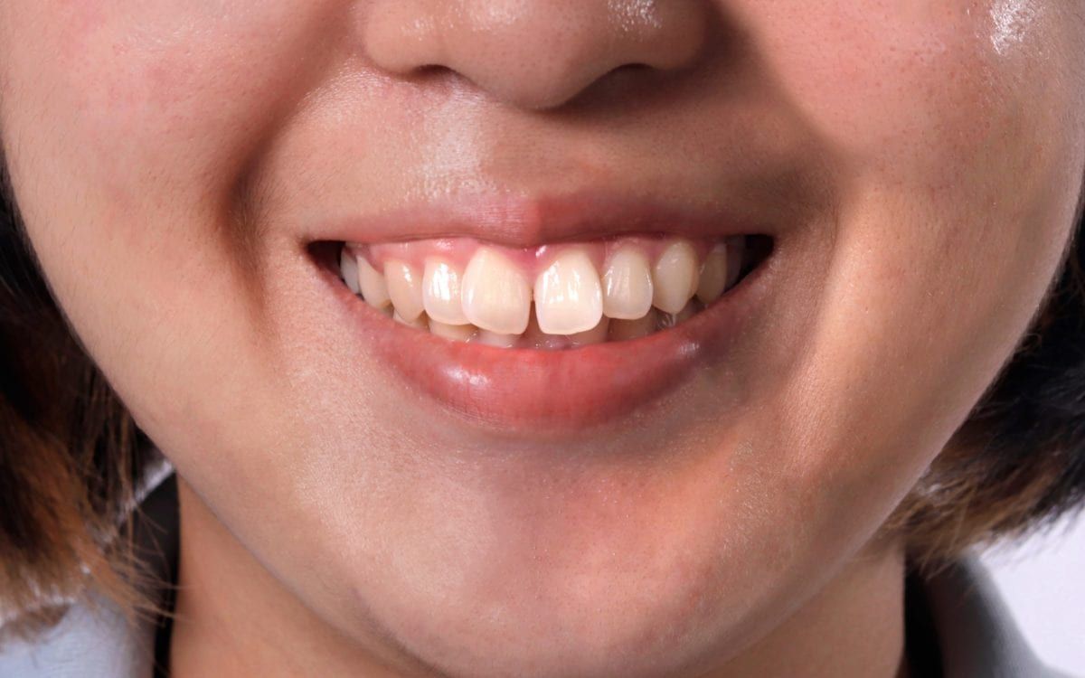 Smiling Person With Misaligned Teeth