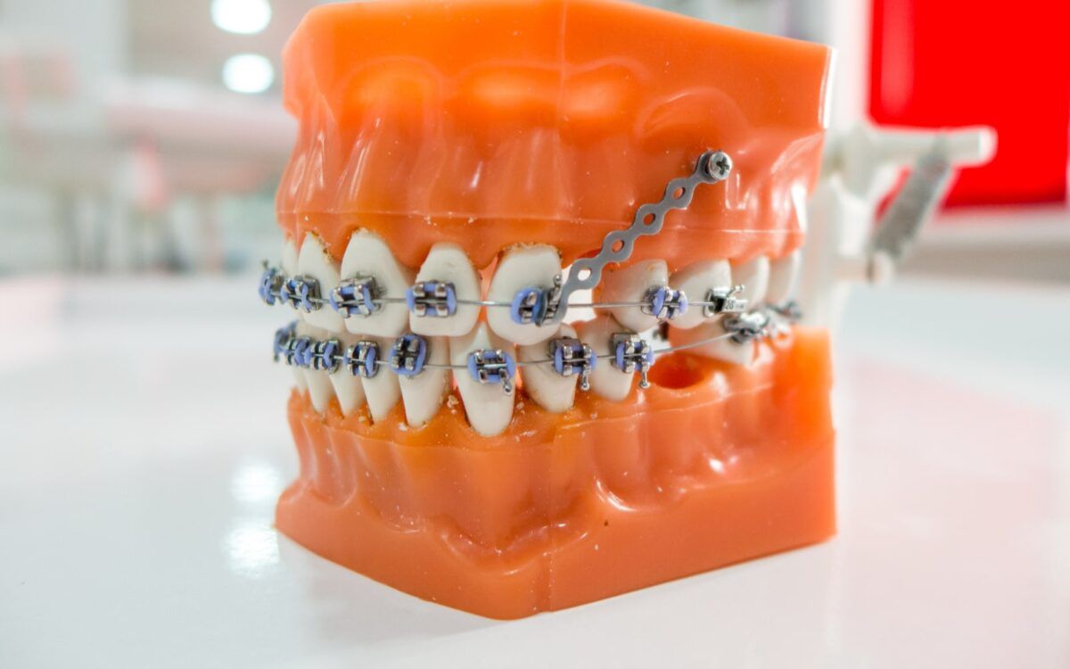 Orthodontic Anchorage