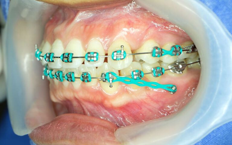 Orthodontic Anchorages