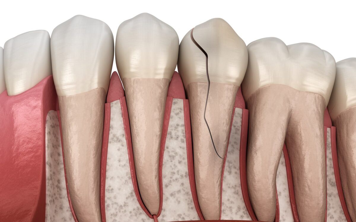 Dental Fracture Vector Image