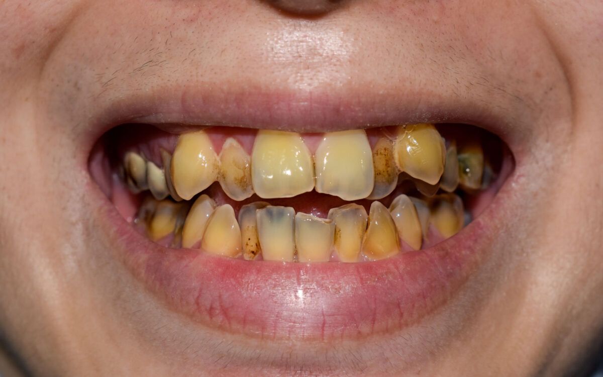 Stained teeth with cavities