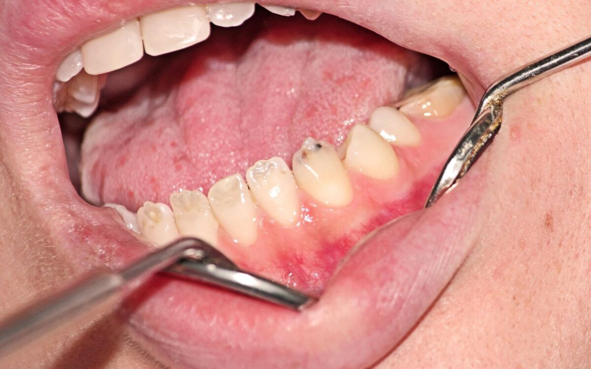 Dentinogenesis Imperfecta