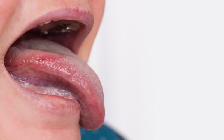 Oral lichen planus symptoms
